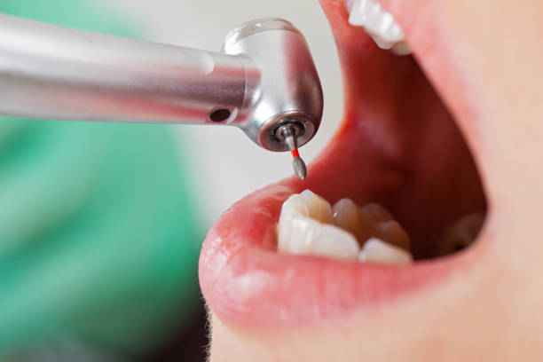 Best Emergency Wisdom Tooth Extraction in Wisr, NE